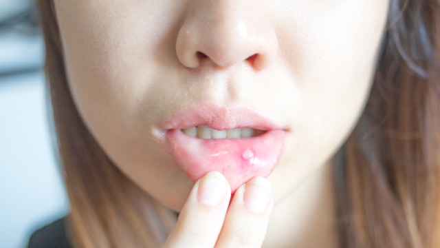 Mulher puxa o lábio inferior, mostrando mancha branca na boca, sinal típico de sapinho na boca (candidíase oral).