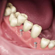 Dentes artificiais, agrupados em uma ponte, são encaixados nos pinos