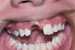 Dente permanente arrancado