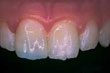Dente lascado após a restauração