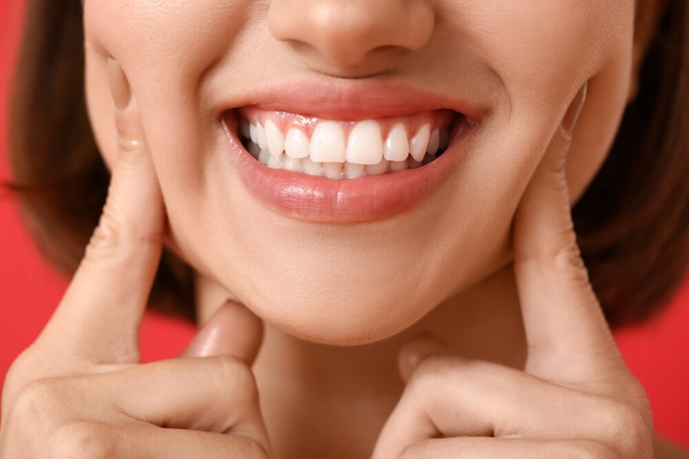 Close-up de sorriso com dentes alinhados e brancos, ilustrando resultado estético de lentes nos dentes.