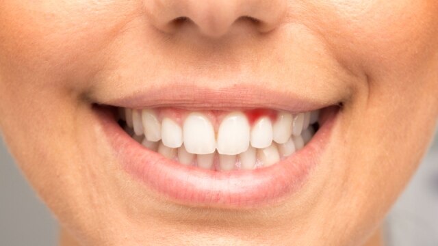 Mulher sorrindo para mostrar carne crescida no dente, termo popular para tecido gengival que parece crescer ao redor do dente