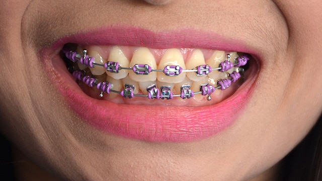 Sorriso com aparelho ortodôntico e borrachinhas roxas, destacando uma das melhores cores de aparelho para um visual vibrante.