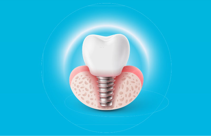 Ilustração em 3D de um dente saudável com implante dentário e pino de metal, com destaque luminoso e fundo azul, representando procedimento odontológico