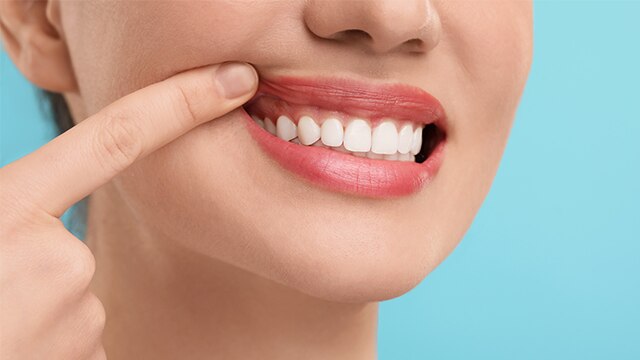 Close-up de sorriso com dedo apontando a gengiva, mostrando resultado da gengivoplastia para harmonizar o contorno gengival.