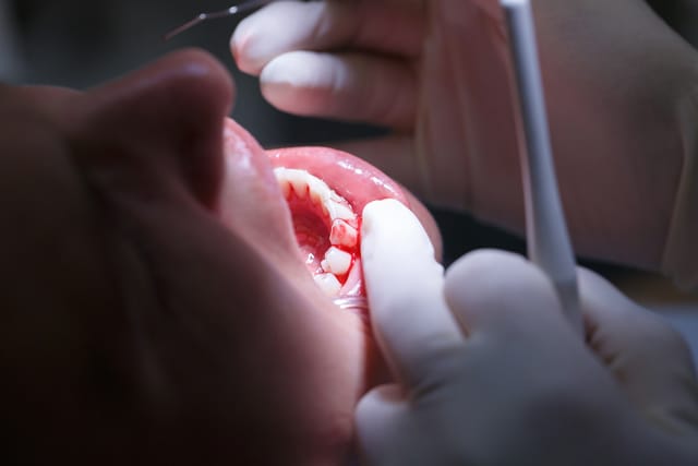 close de uma pessoa com a boca aberta durante o atendimento de um tratamento na gengiva no consultório odontológico.
