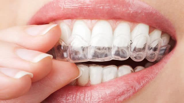 dentes de uma mulher com invisalign