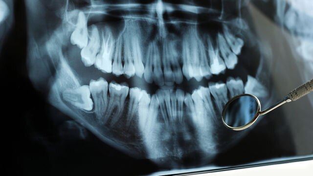 imagem de um raio-x de uma arcada dentária.