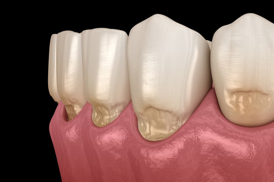 Ilustração 3D de Abfração dos dentes anteriores