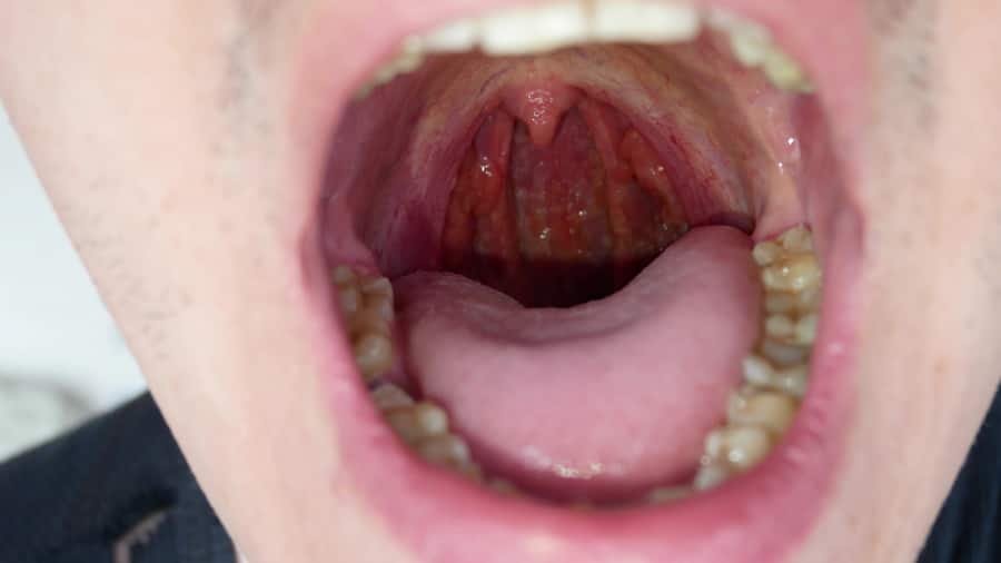 O homem mostra a garganta para ver língua e as amígdalas.