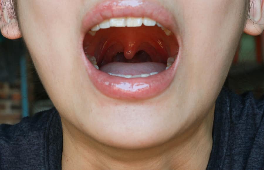 uma boca aberta com uma úvula inchada 