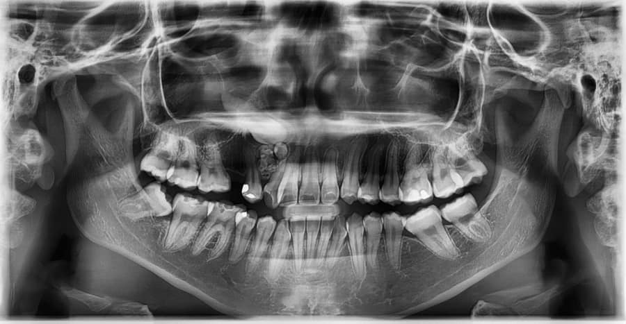 Radiografia panorâmica mostra caninos e segundos pré-molares embutidos no maxilar direito com odontoma.