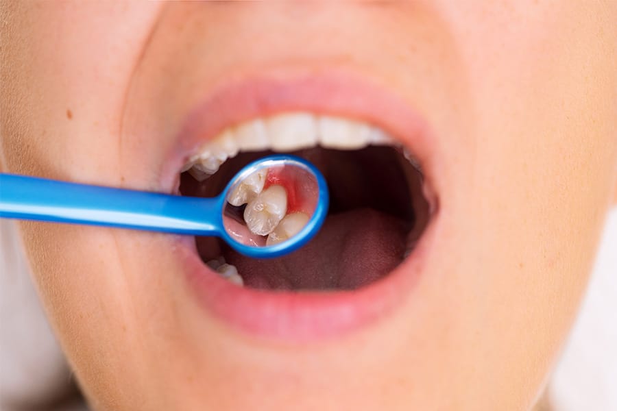 imagem de uma boca aberta durante realização de exame oral feito por um(a) dentista.