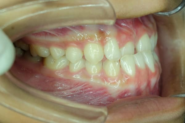 Dentes de mordida cruzada frontal inferior