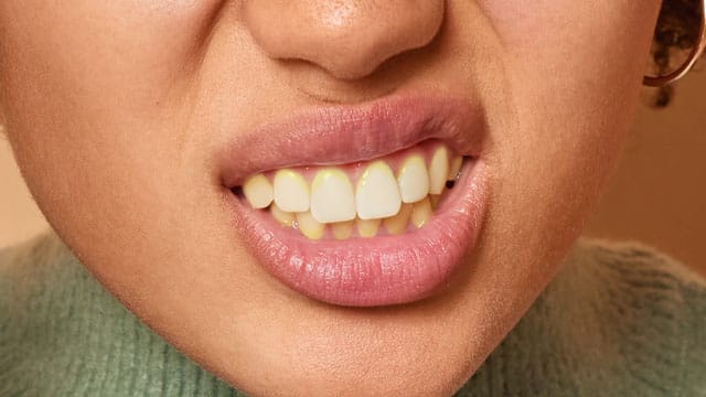 Boca de mulher mostrando os dentes com tártaro