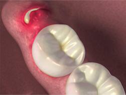 Crowded and impacted wisdom tooth