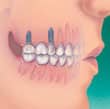 Implantes servem de base para dentes substitutos isolados