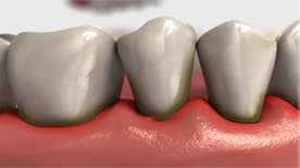 Exemplo de periodontite
