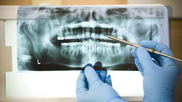mãos de dentista com luvas azuis segurando e analisando um raio-x odontológico e um instrumento de metal.