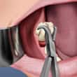 Fórceps dentário é utilizado para remover o dente