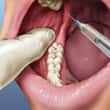 A área em volta do dente é anestesiada antes da extração