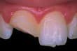 Dente frontal lascado