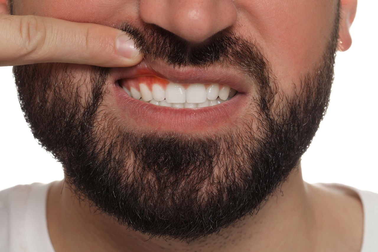 Homem mostrando a gengiva inflamada, indicando gengivite, que pode ser um dos sintomas de diabetes