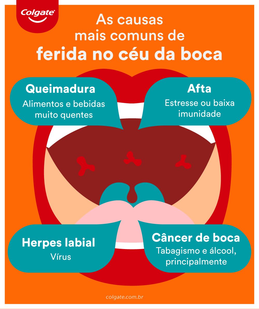 ferida-no-ceu-da-boca-infografico-colgate.jpg