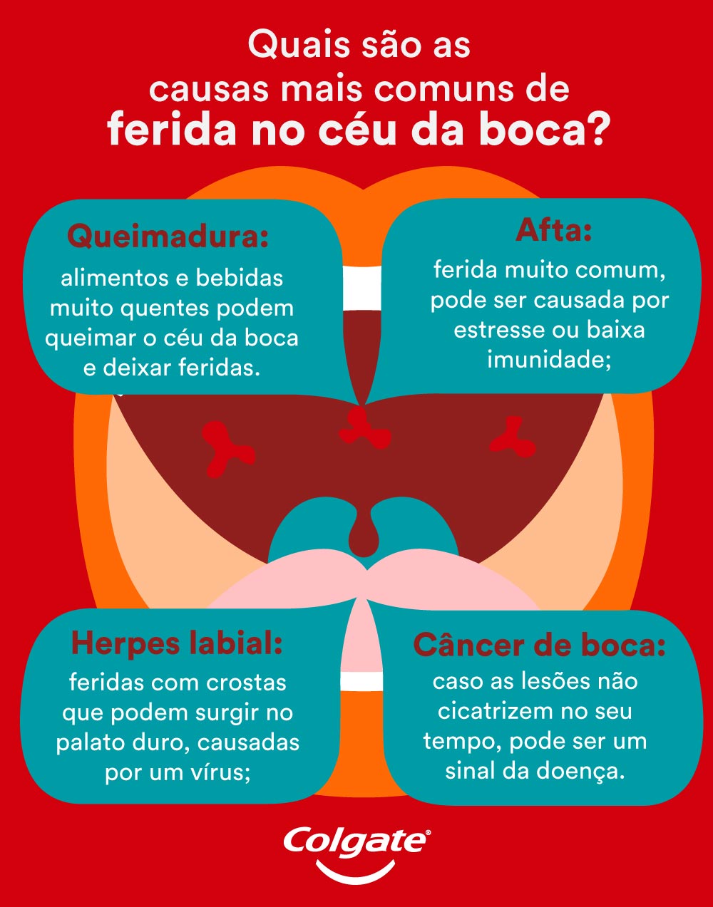 Infográfico com 4 motivos que causam ferida no céu da boca