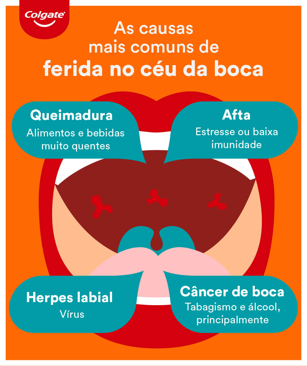 Infográfico explicando as causas das feridas no céu da boca.
